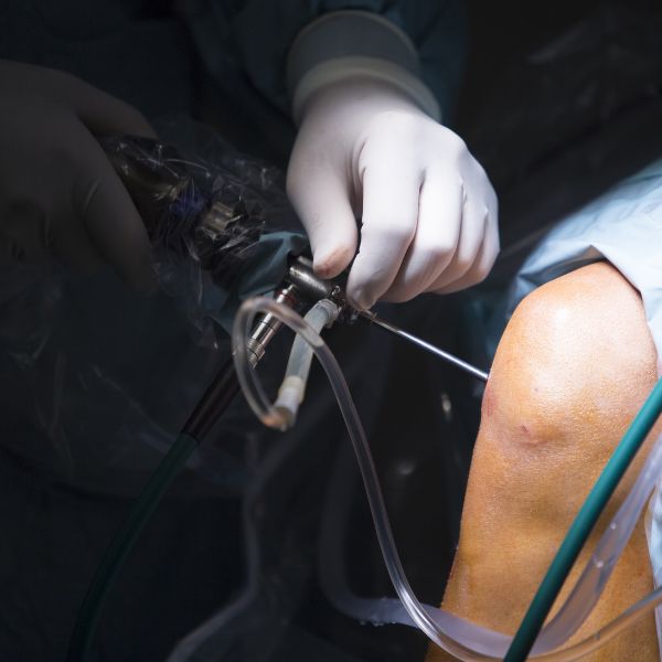 a doctor performing knee arthroscopy operation