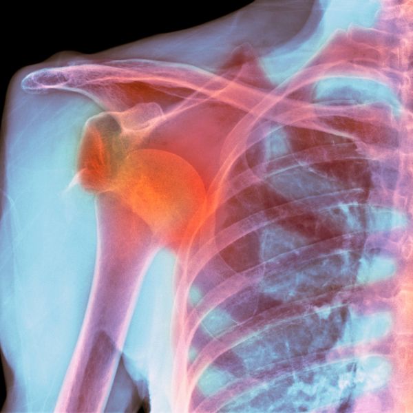 Illustration of a shoulder dislocation