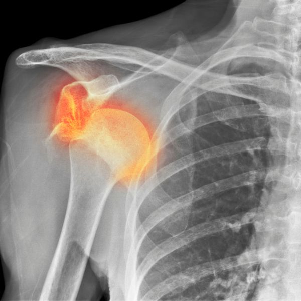 Shoulder injury x ray