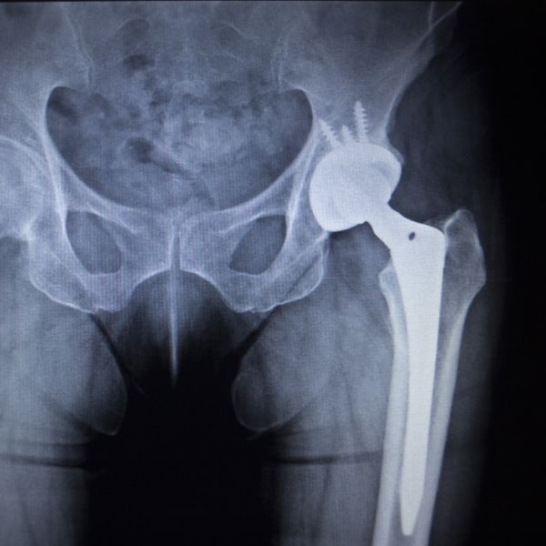 X ray of a hip replacement