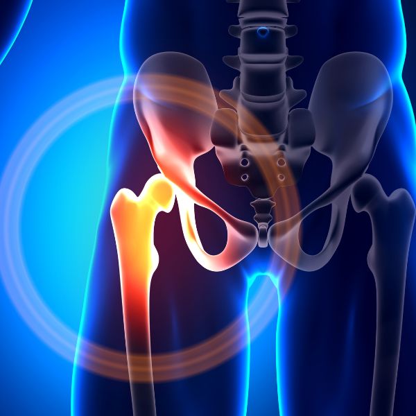 An illustration of AVN Hip Replacement